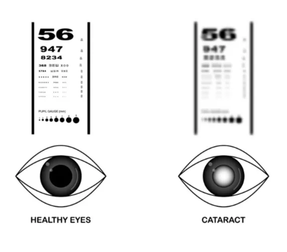 Healthy Eyesight vs Cataracts Visual Acuity Comparison Eye chart and eye structure comparison: healthy clear vision versus blurred cataract vision.